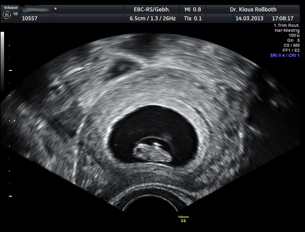 8 Ssw Embryo Zu Klein Aber Herzschlag Wie sieht ein Ultraschallbild in der 8 SSW aus?