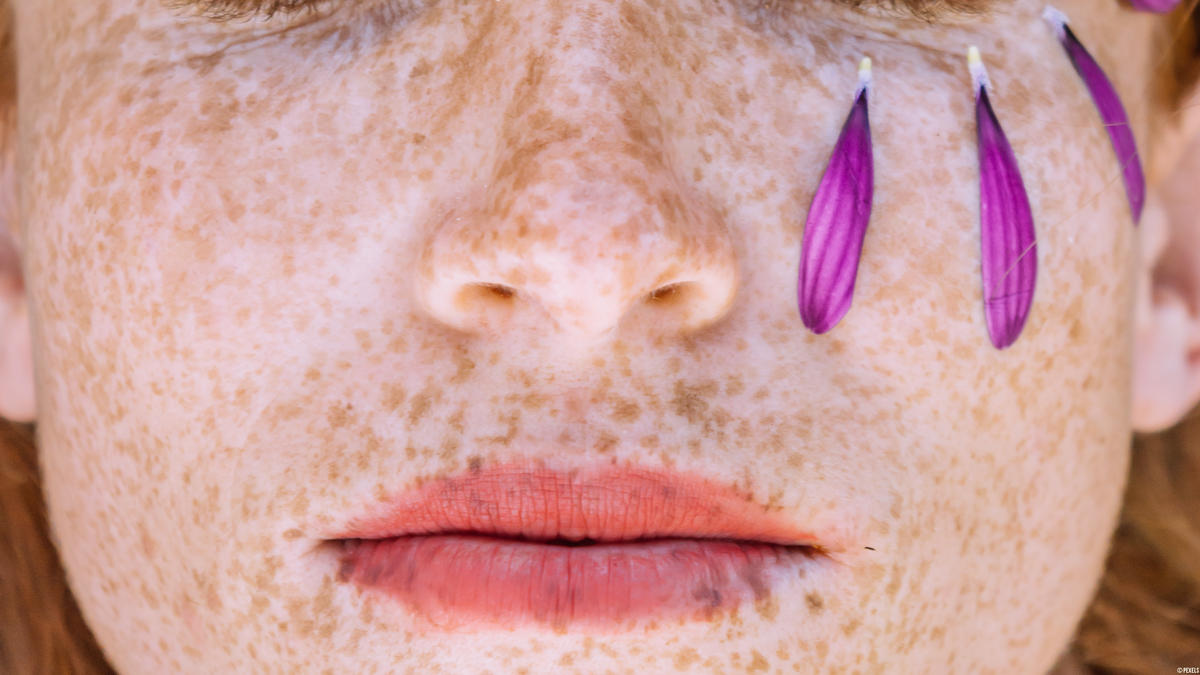 Was kann man gegen Pickel auf der Lippe machen?