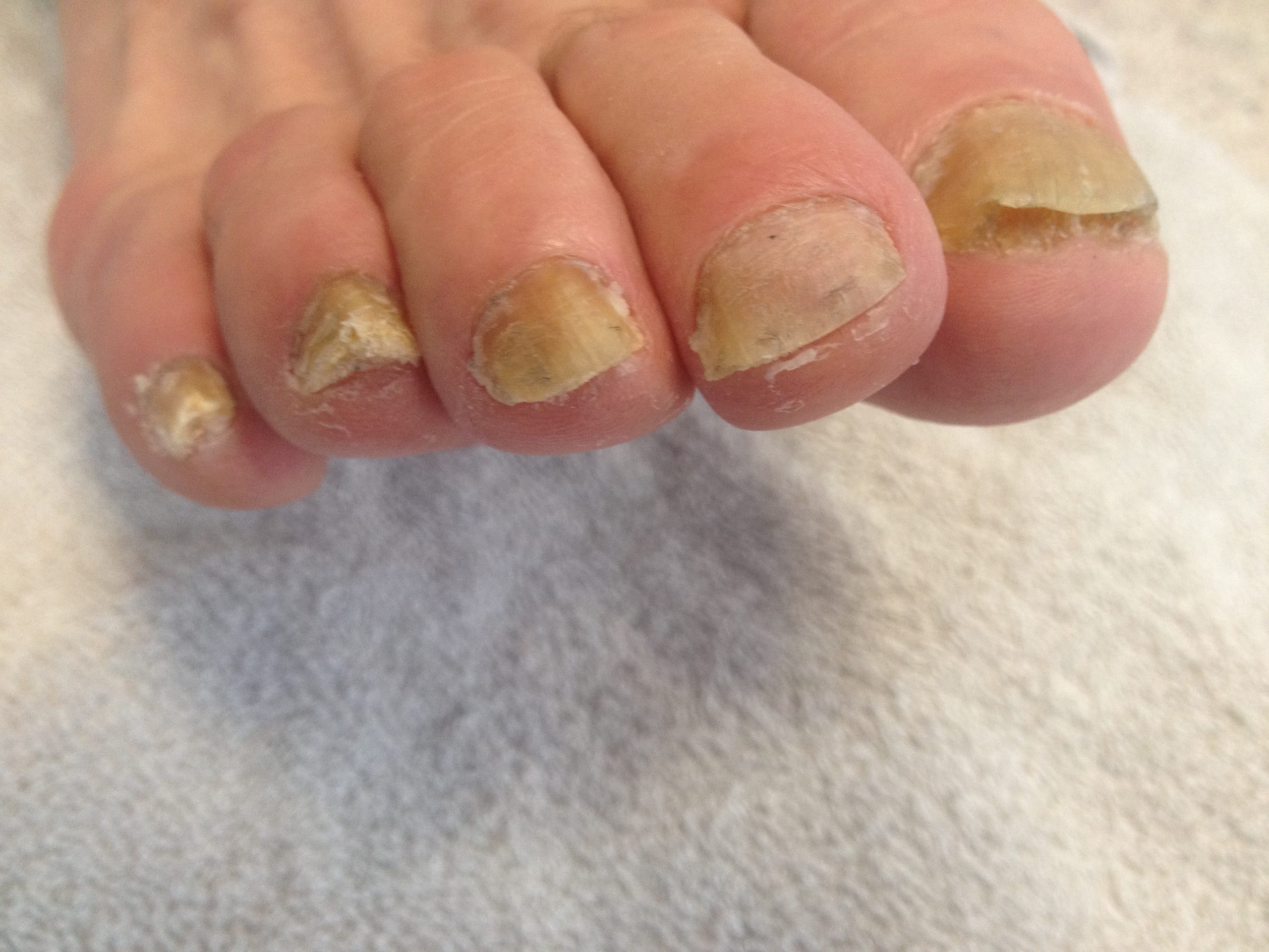 Was Tun Bei Nagelpilz Am Zeh Hausmittel Was hilft bei hartnäckigen Nagelpilz?