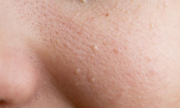 Faszinierend Abszess Schamlippe Hausmittel Ebenbild