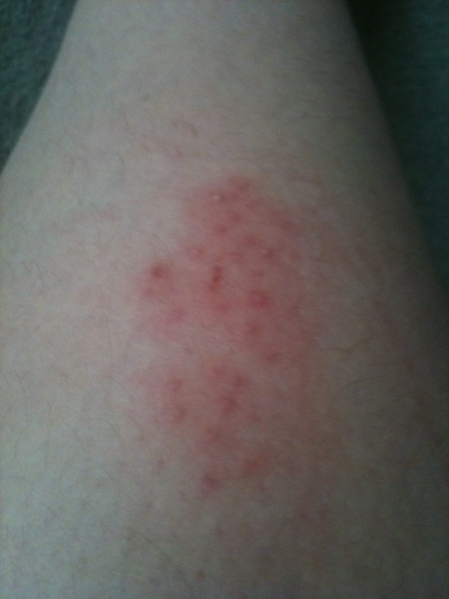 Wie sieht ein Ausschlag aus?
